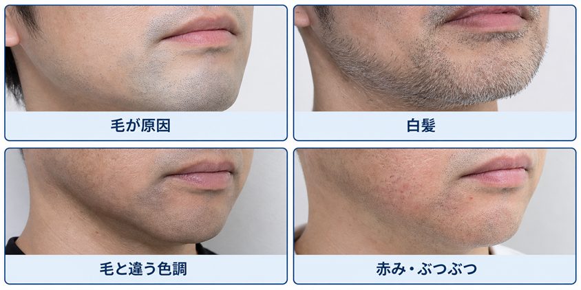 青髭に見える4つの状態を比較した図解