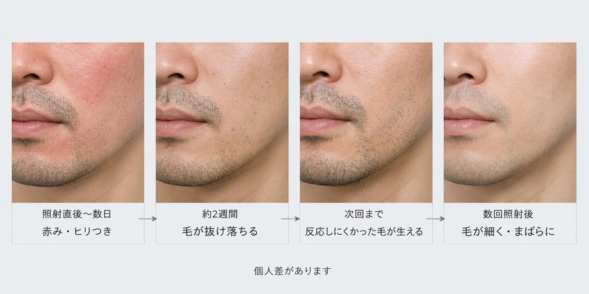 ヒゲ脱毛後の赤みから抜け落ち、反応しにくかった毛が生え、毛が細くなるまでの変化を示す図解