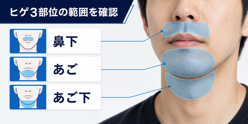 ヒゲ脱毛の鼻下・あご・あご下の3部位を示す図解