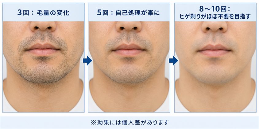ヒゲ脱毛の回数別変化の目安を示す図解