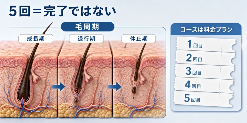 毛周期と5回コースが完了保証ではないことを示す図解