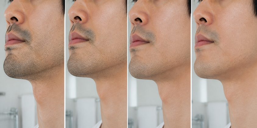 ヒゲの濃さが段階的に変化する様子を並べた男性の口元